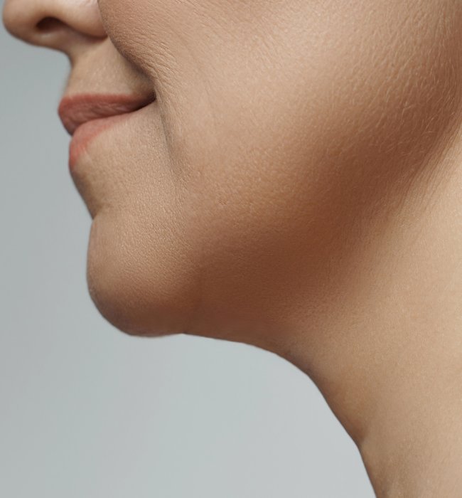 Kybella double chin reducer