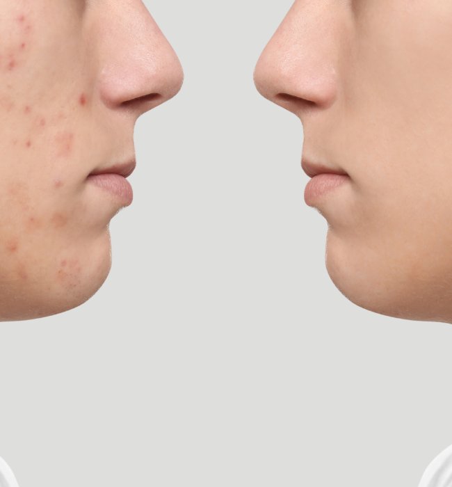 neoclear for acne before and after