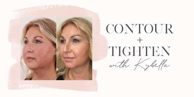 Contour + Tighten with Kybella