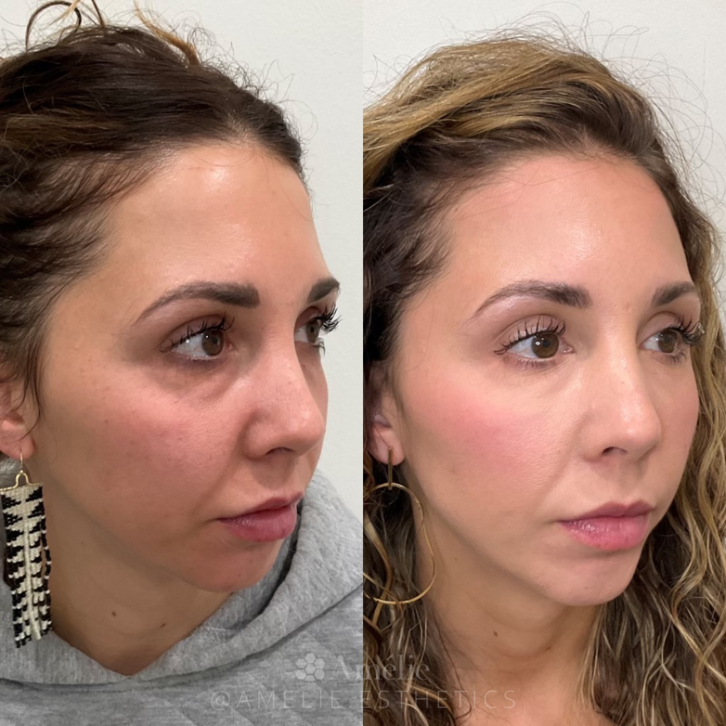 PRF treatment before and after in Tigard, wa med spa