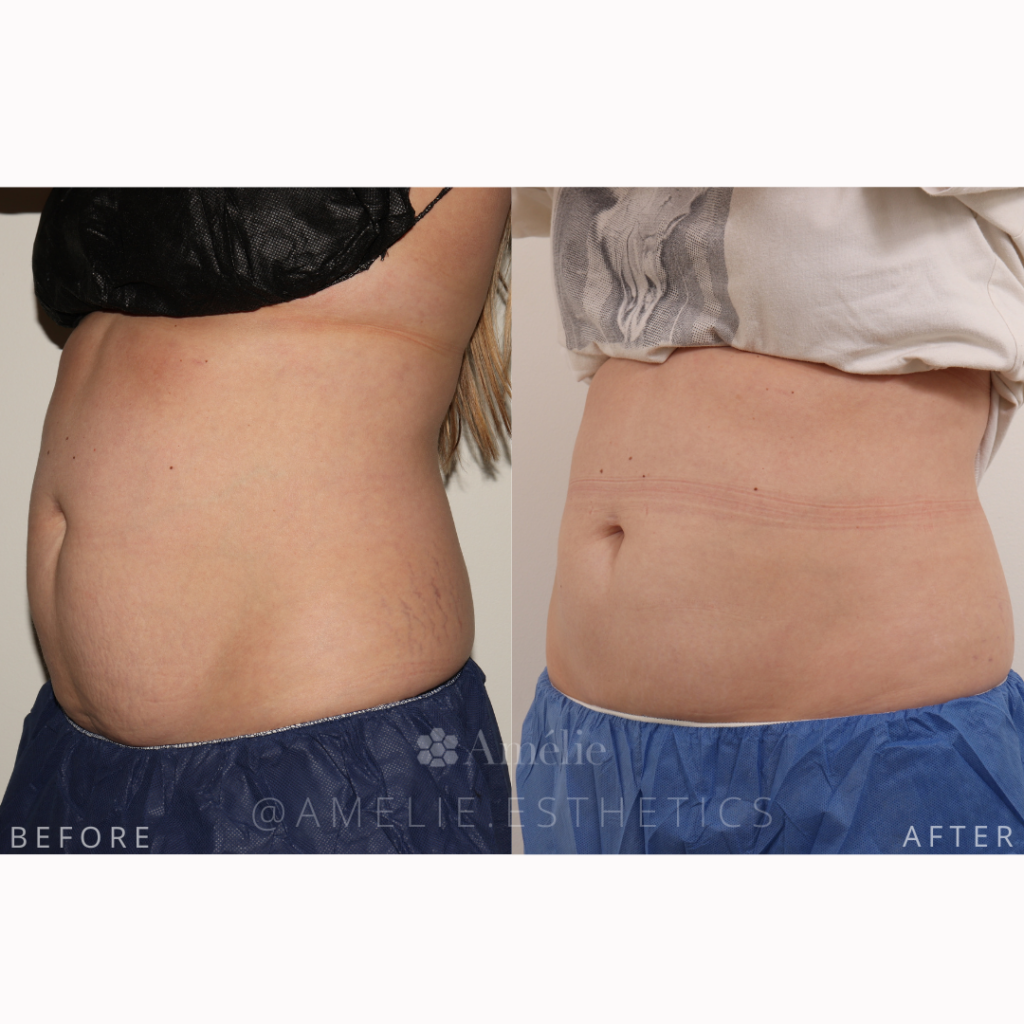 CoolSculpting Elite