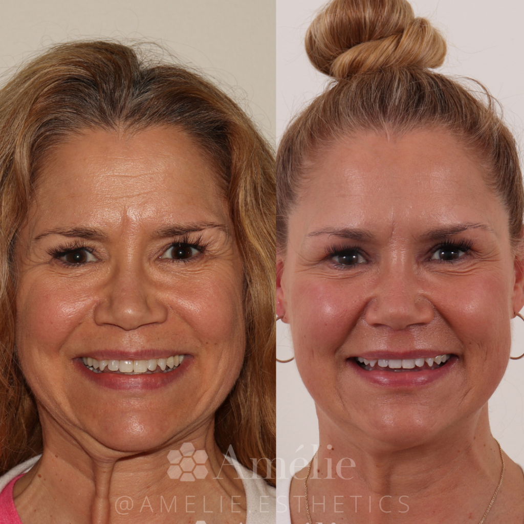 Female before and after sculptra treatment with micronnedling and botox