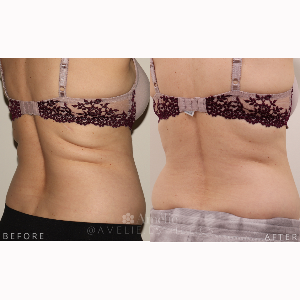 CoolSculpting® Back/Bra Roll Photo Gallery