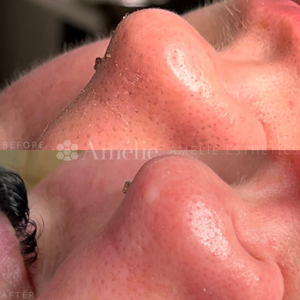 DiamondGlow facial before and after nose