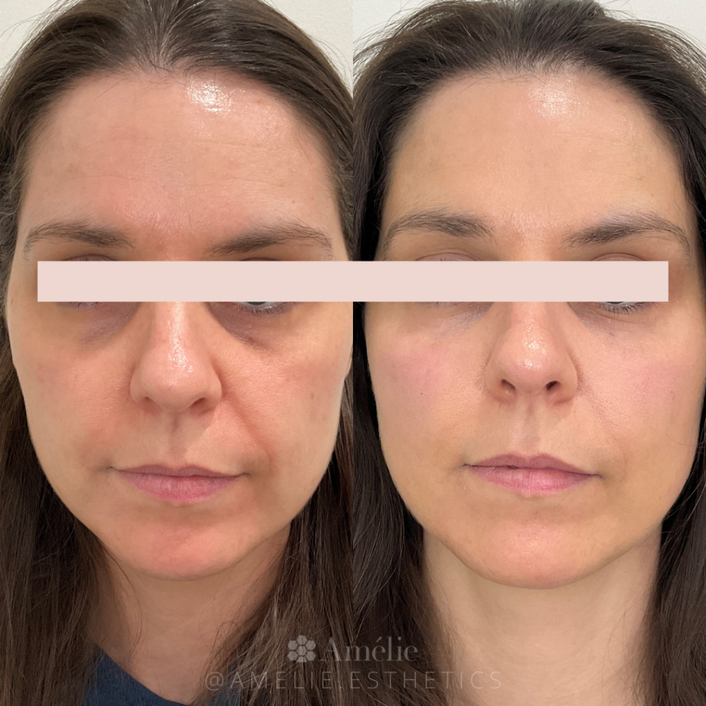 PRF Injection before & after. Injected under eye area to reduce darkness. Model is a Female age 35.