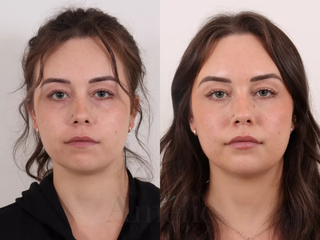 woman with dermal filler before and after