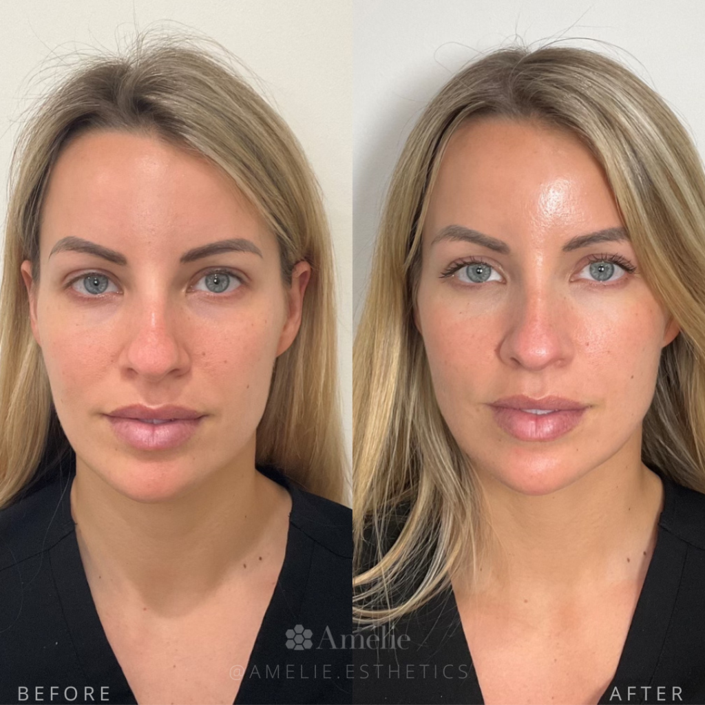 Female age 30 with Sculptra treatment and botox before and after