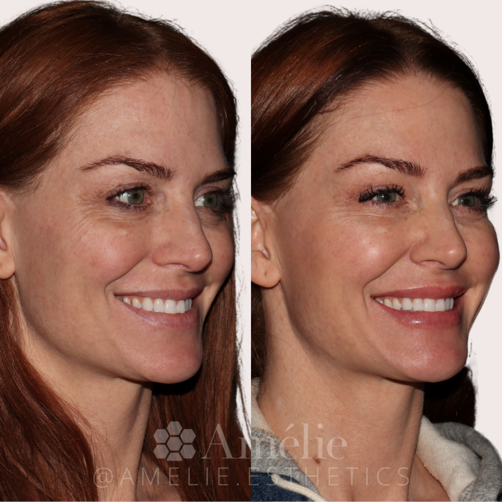 Female before & after sculptra treatment