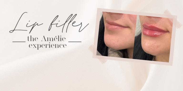 Lip filler- the Amélie experience