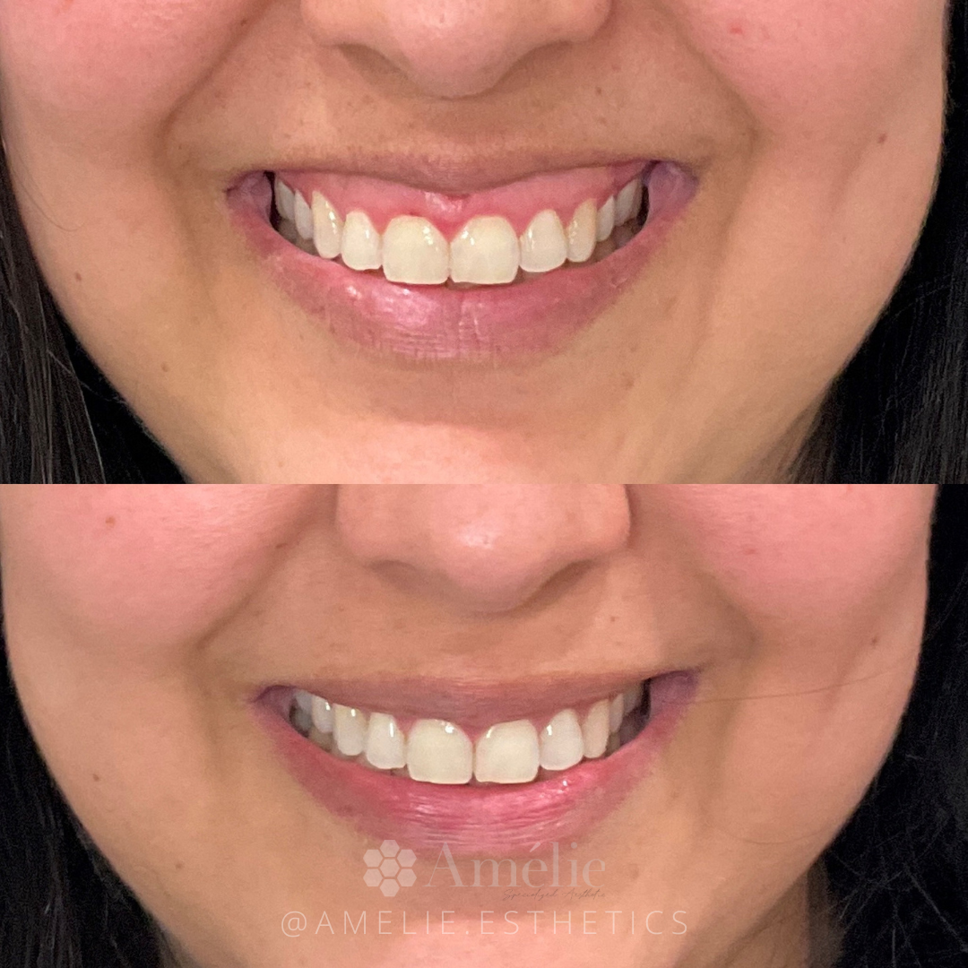 botox lip flip and botox gummy smile before and after