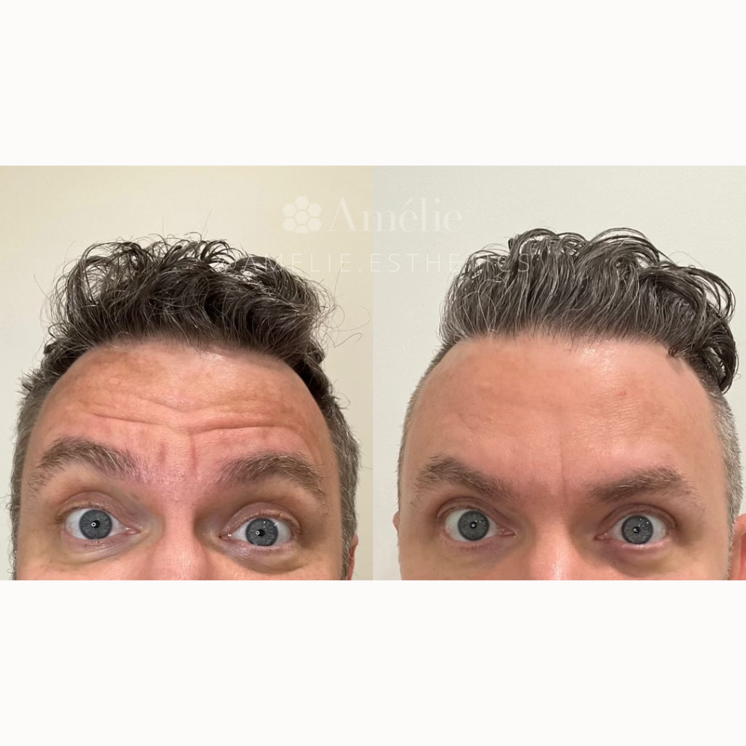 male botox results