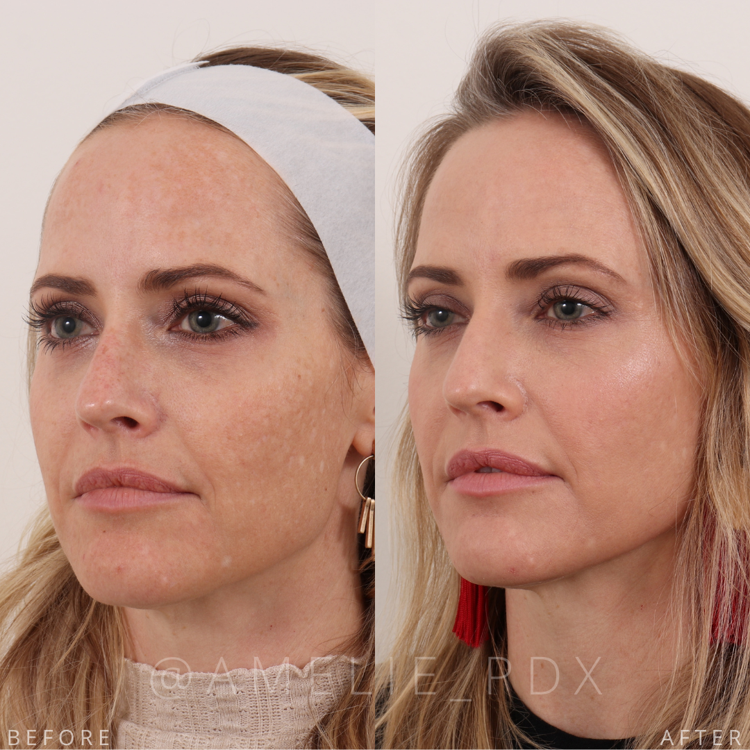 Chemical peel treatment before and after