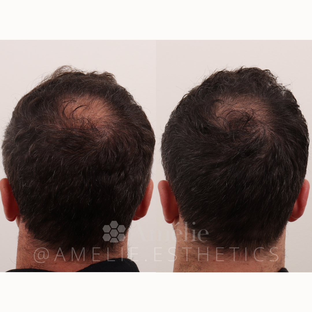 PRF hair rejuvenation before and after
