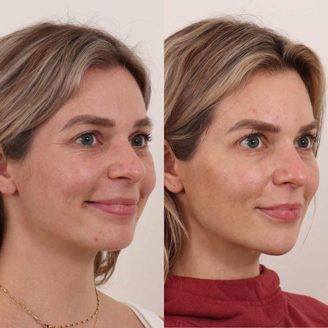 Filler before and after
