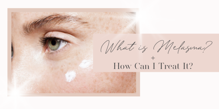 What is melasma and how can I treat it?