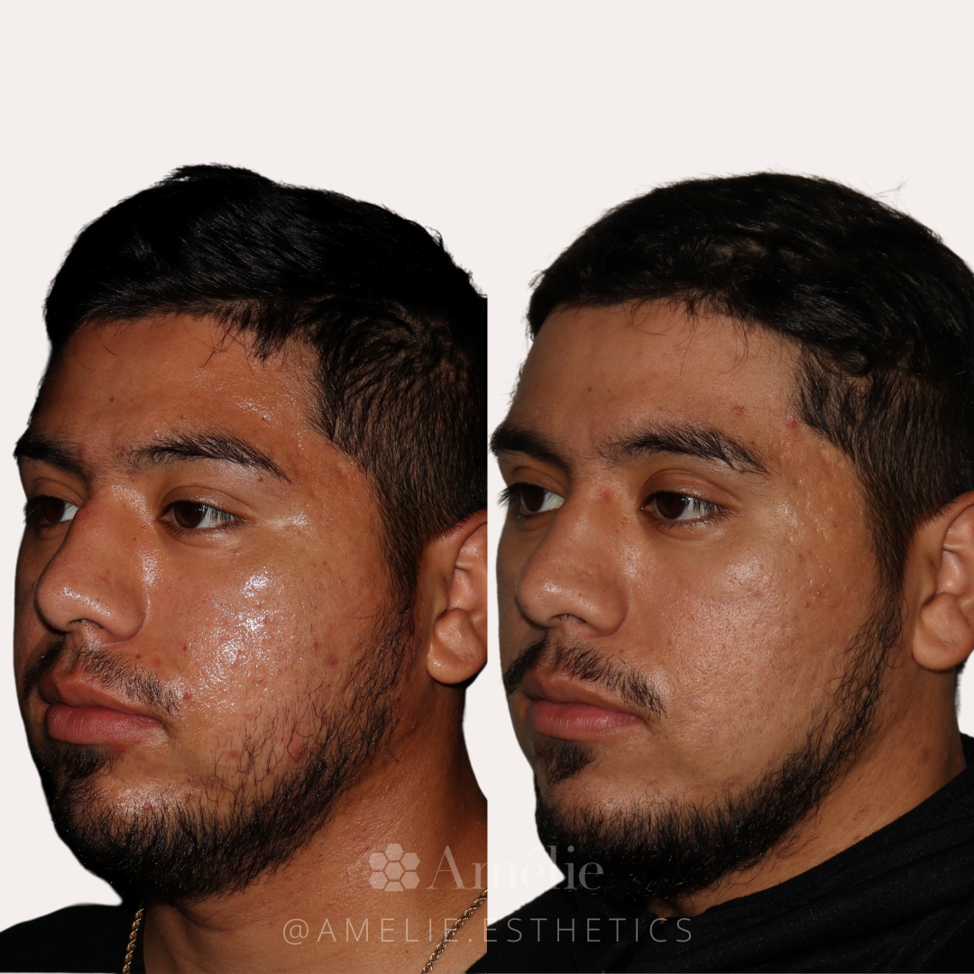 Male microneedling before and after at Am&eacute;lie Med Spa
