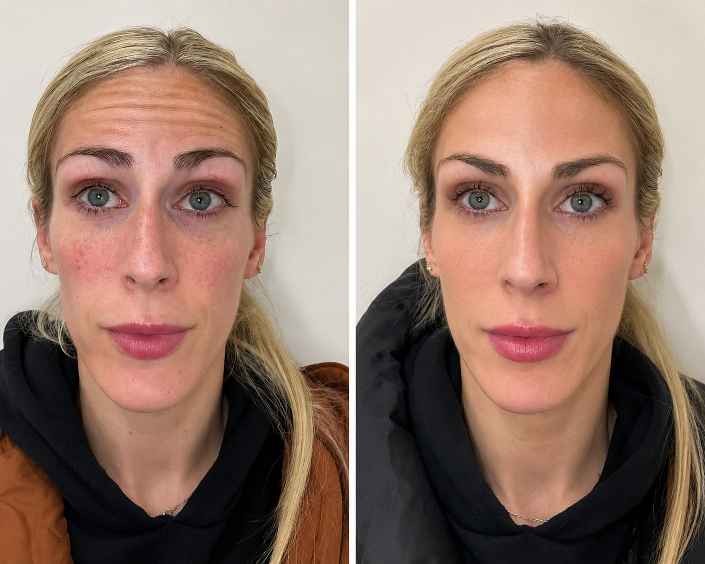 Wrinkle relaxer result