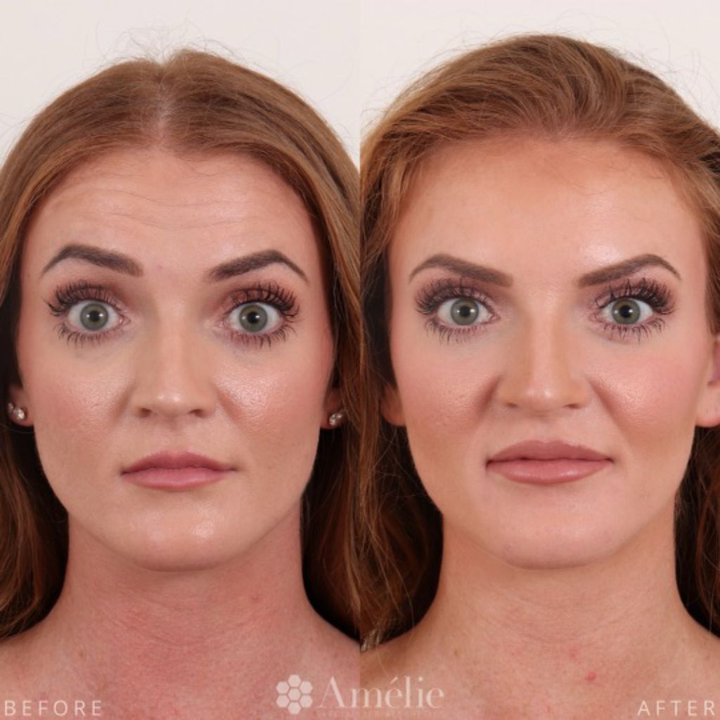 Botox result