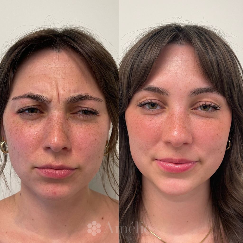 Botox result
